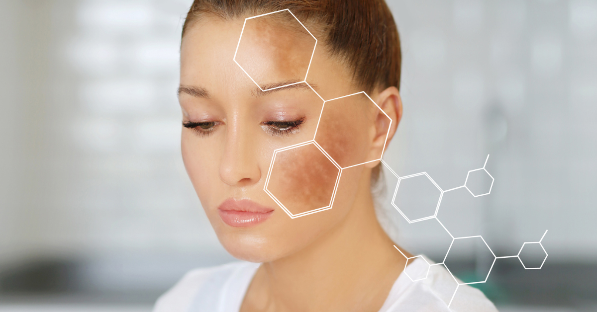Understanding and Managing Postpartum Hyperpigmentation: A ...